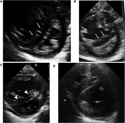 Case report: High-dose epoprostenol therapy in pediatric patients with pulmonary hypertension and developmental lung disease